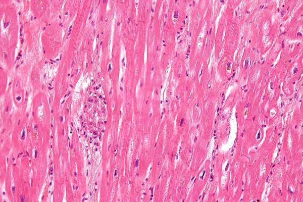 1024px Rheumatic heart disease 3 high mag