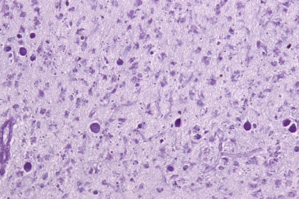 Neuronal ceroid lipofuscinosis PAS 1