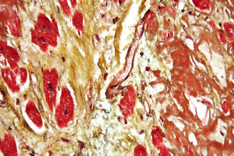 heart20disease1 768x512