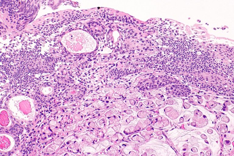 Signet ring cell carcinoma of the urinary bladder head1 768x512